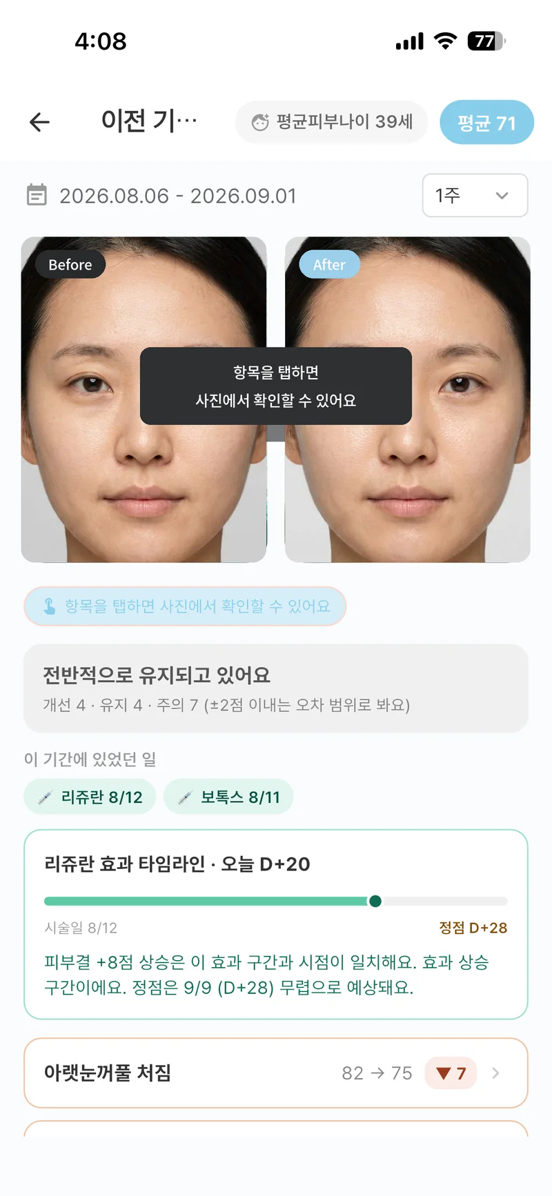 SkiNote 전후 비교 화면 — Before/After와 항목별 점수 개선